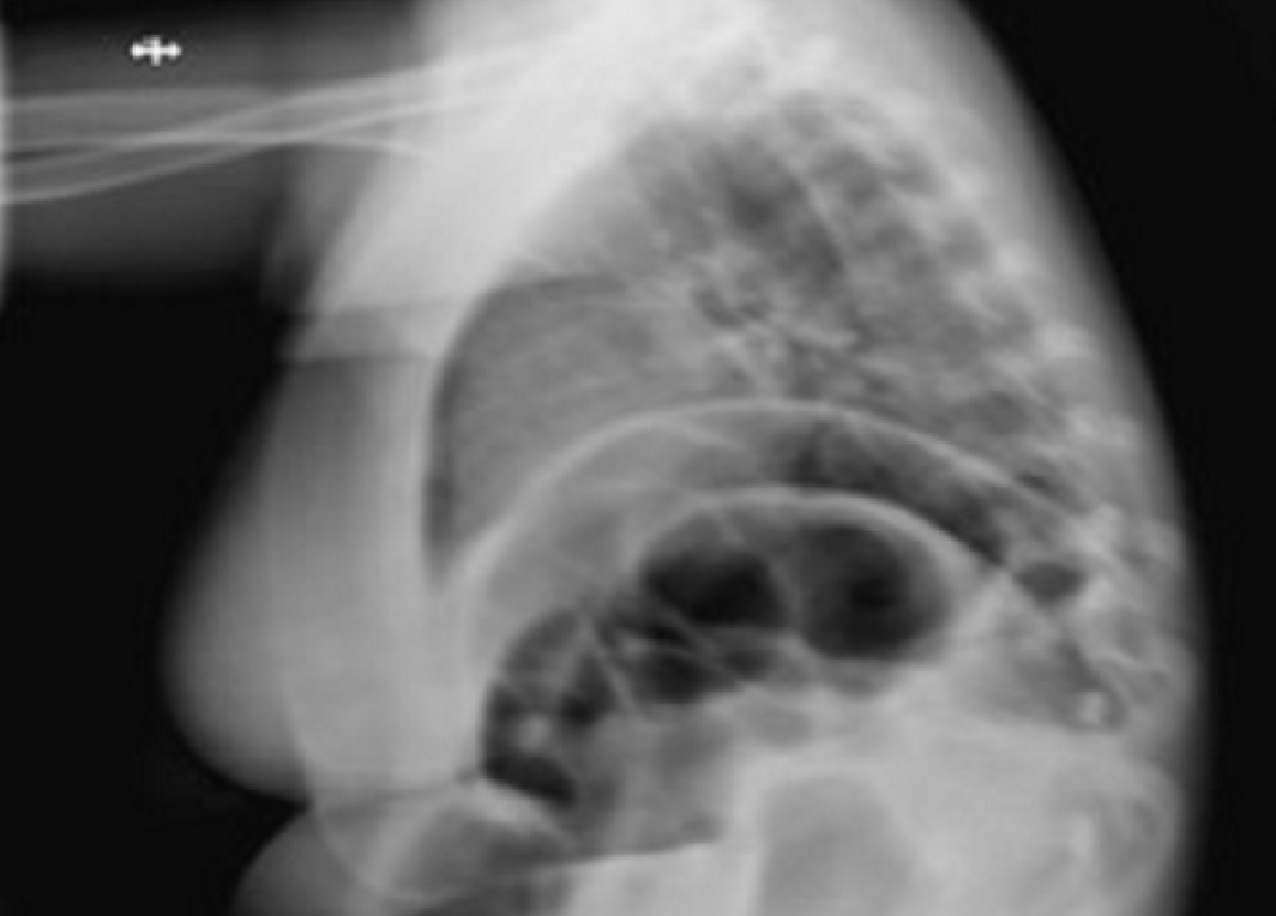 Esta radiografía borrosa ilustra cómo el movimiento puede afectar a las imágenes de rayos X. Fuente: Steven Don/WUSTL