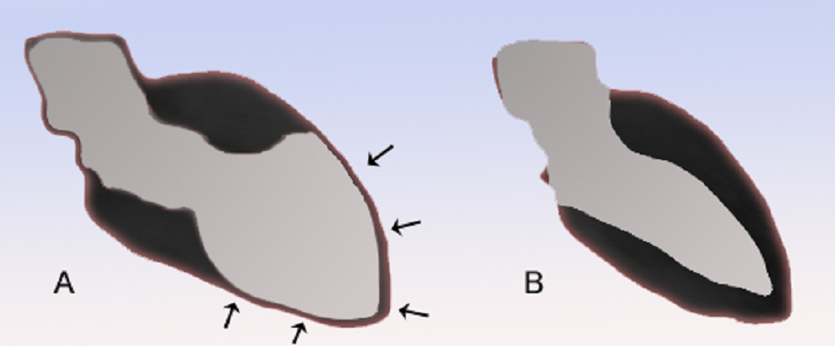 Corazón con síndrome de Takotsubo (A) y normal (B). Imagen: JHeuser. Fuente: Wikipedia.