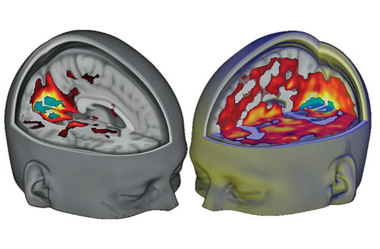 Resonancia magnética funcional de cerebros bajo el efecto de LSD. Imagen: Carhart Harris et al. Fuente: Sinc.