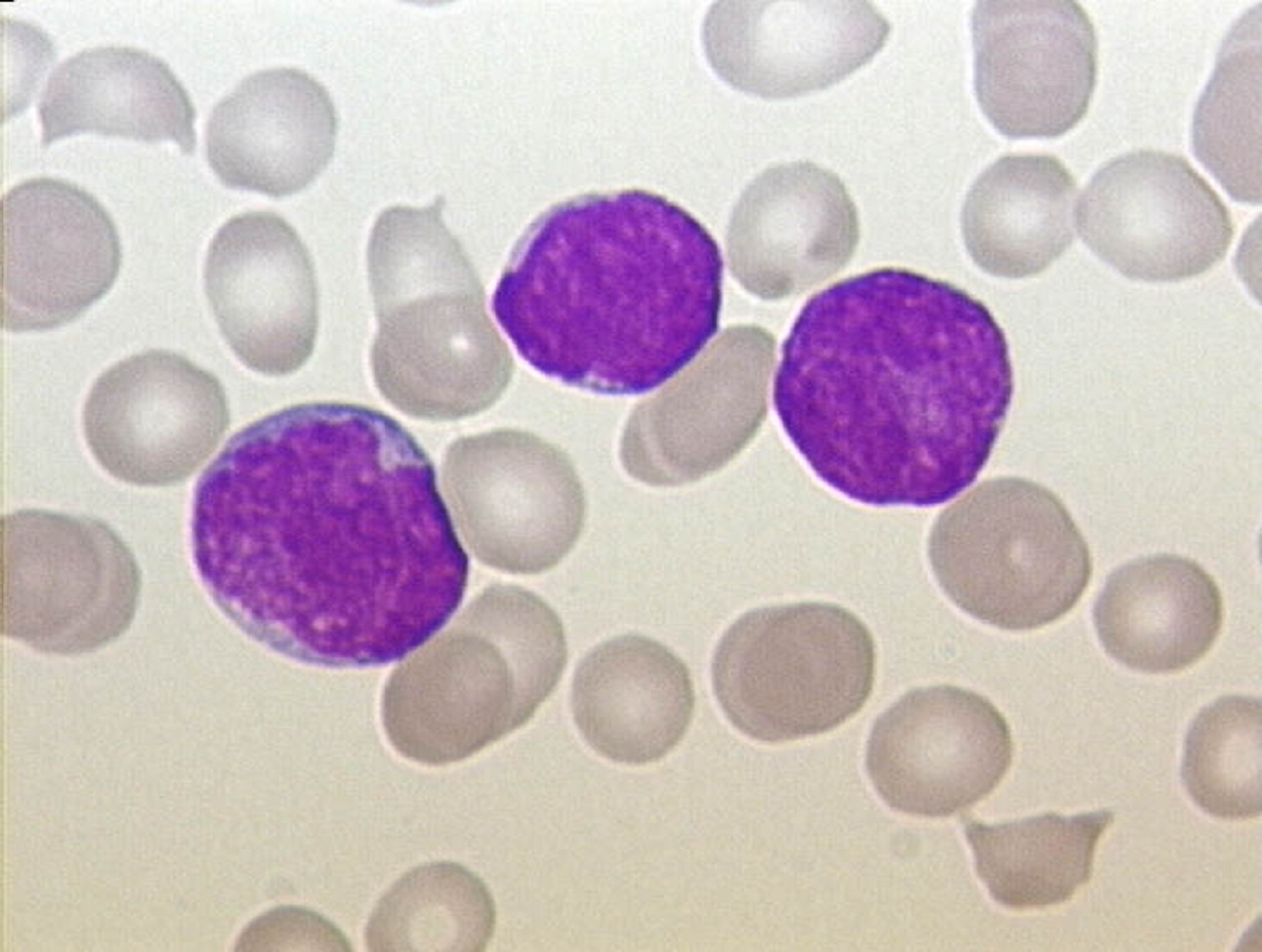 Sangre de un niño con leucemia linfoblástica aguda. Imagen: Christaras A. Fuente: Wikipedia.