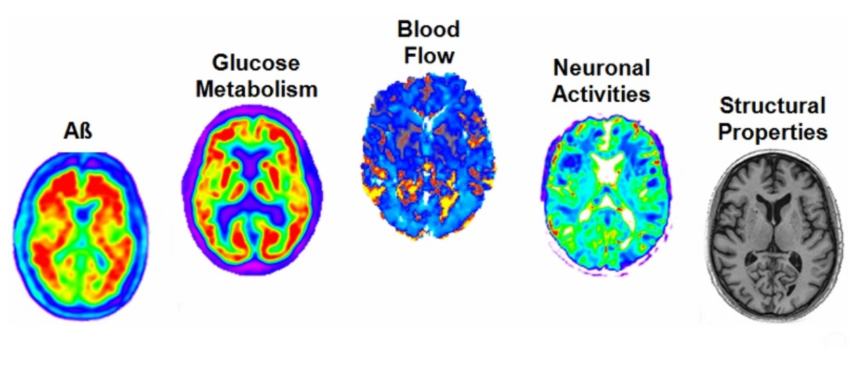 El  estudio  utiliza  la  Resonancia  Magnética  y  la  PET  para  estudiar  las  imágenes cerebrales. Fuente: McGill