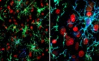 Transforman células cutáneas en células cerebrales humanas