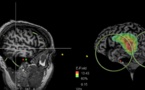 Identifican la zona del cerebro implicada en las voces que oyen los esquizofrénicos